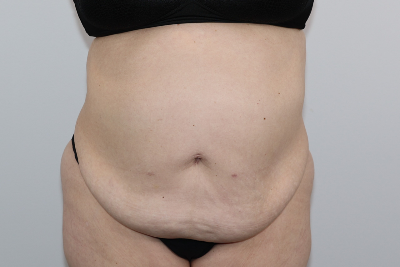 Tummy Tuck