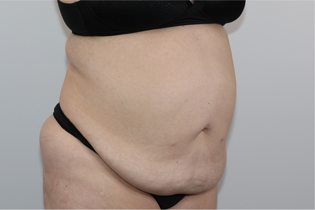 Tummy Tuck