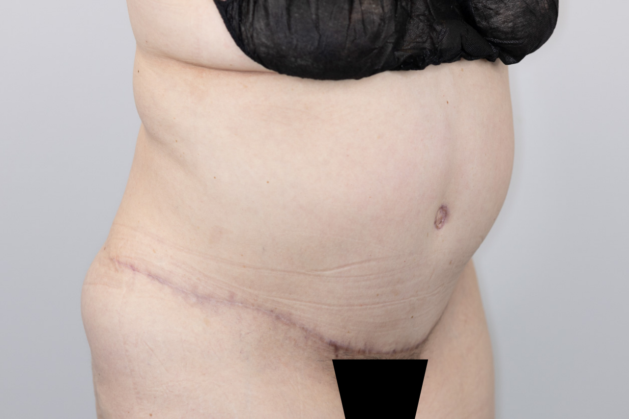 Tummy Tuck