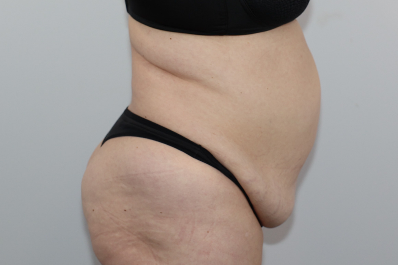 Tummy Tuck