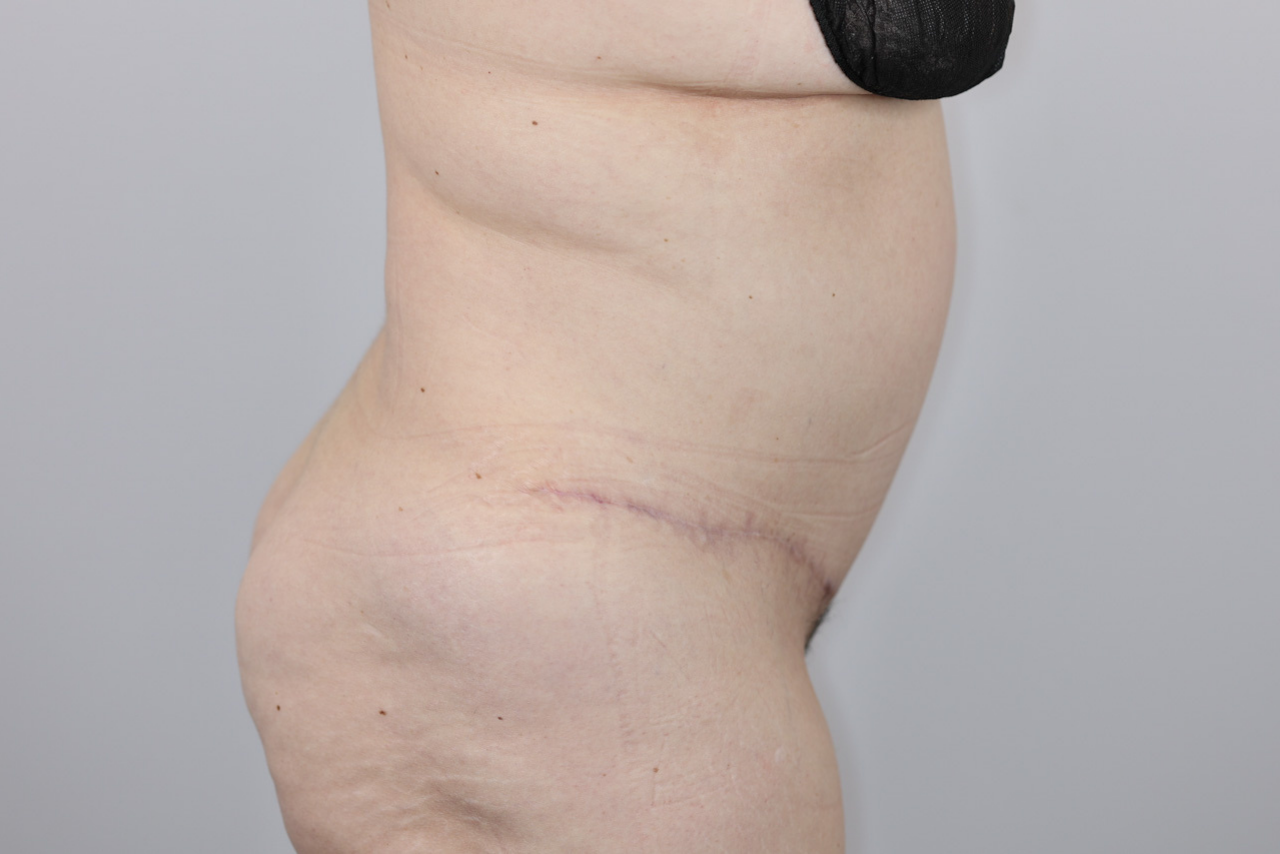 Tummy Tuck