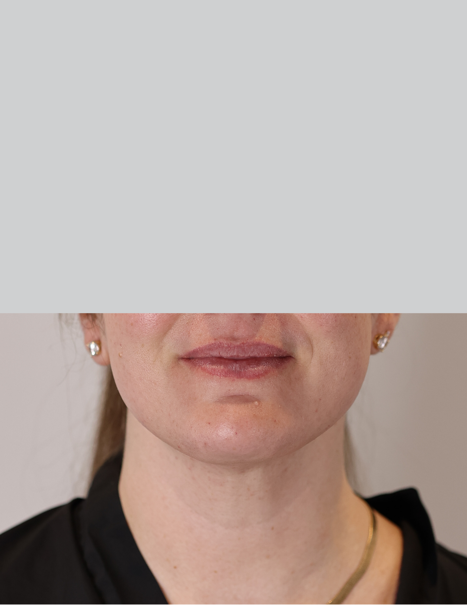 Neck (Chin) Liposuction