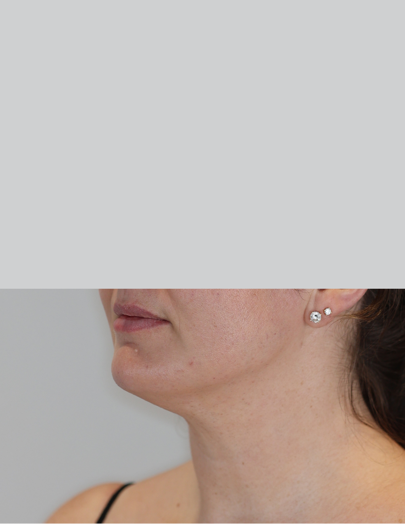 Neck (Chin) Liposuction