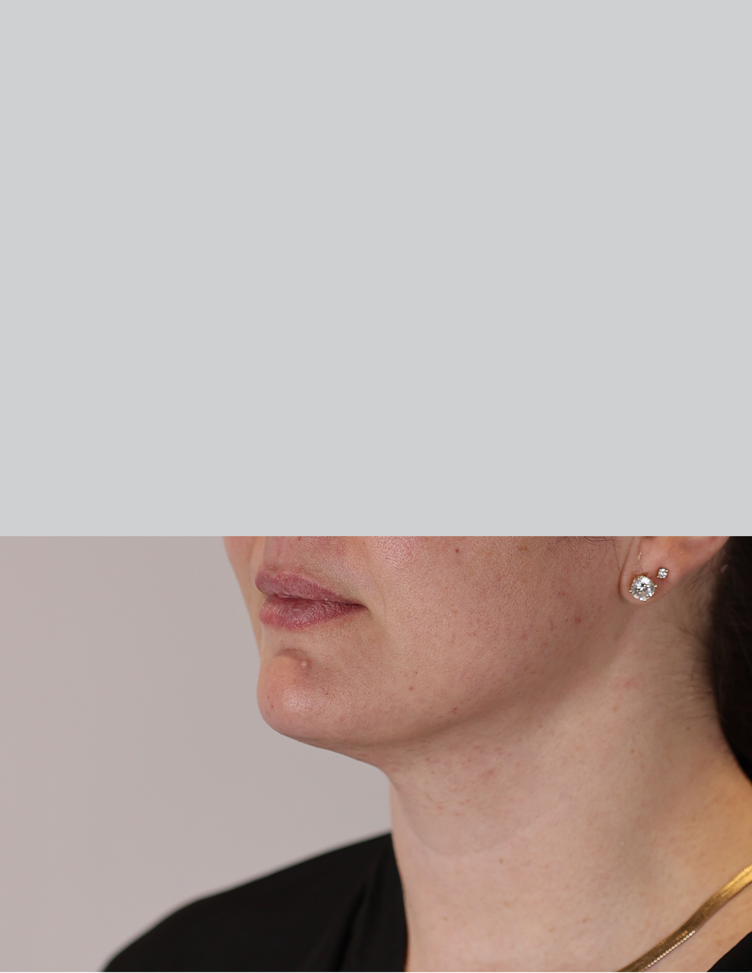 Neck (Chin) Liposuction