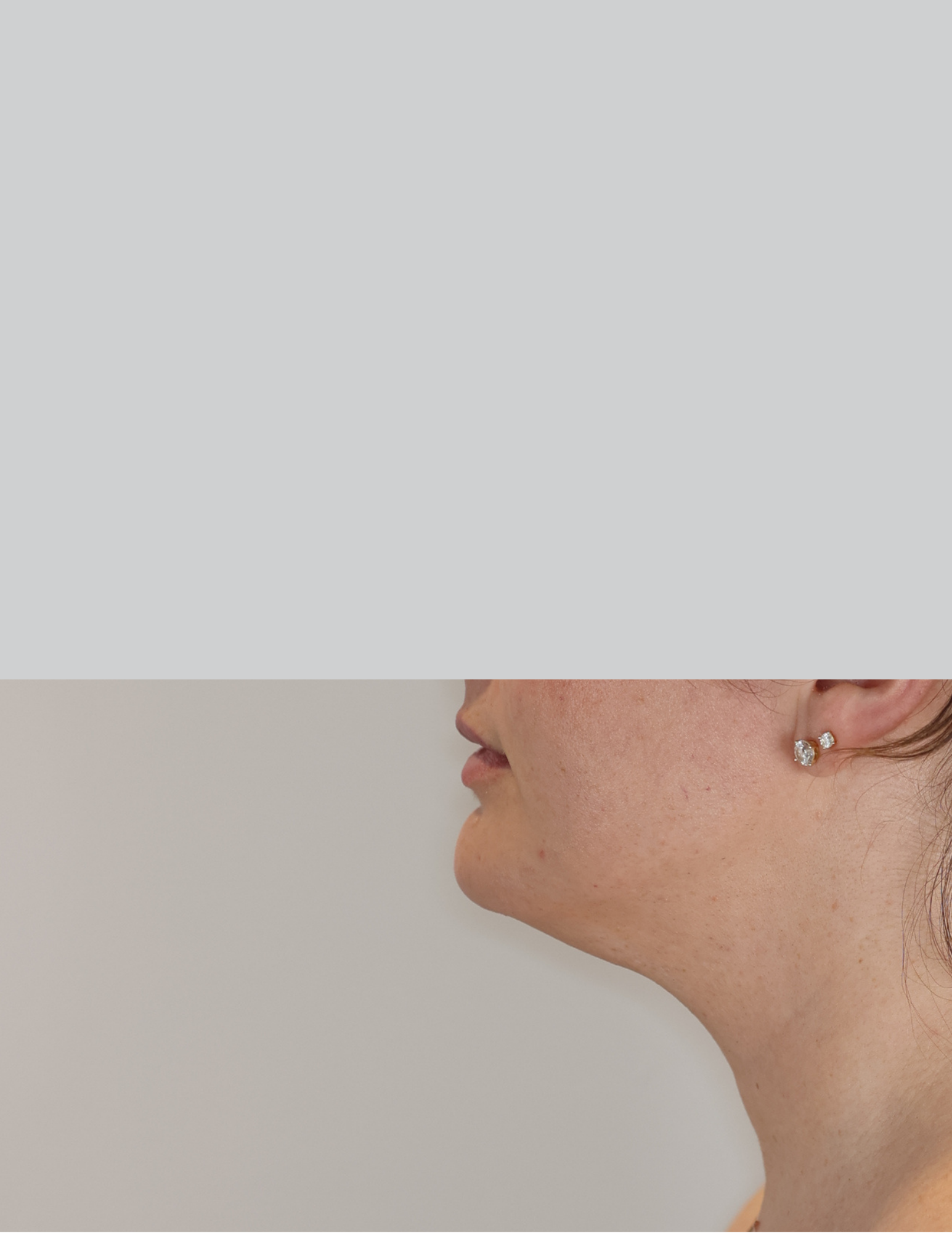Neck (Chin) Liposuction