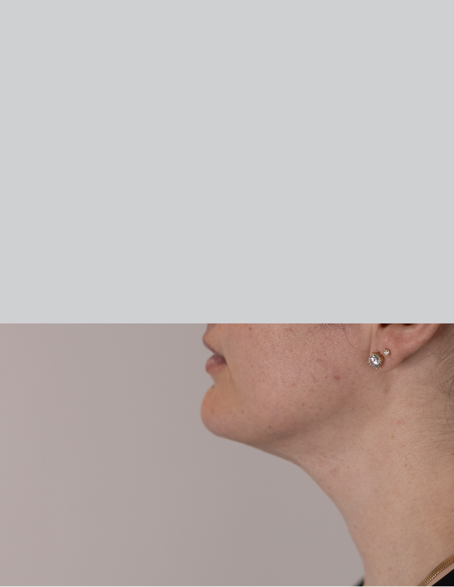 Neck (Chin) Liposuction