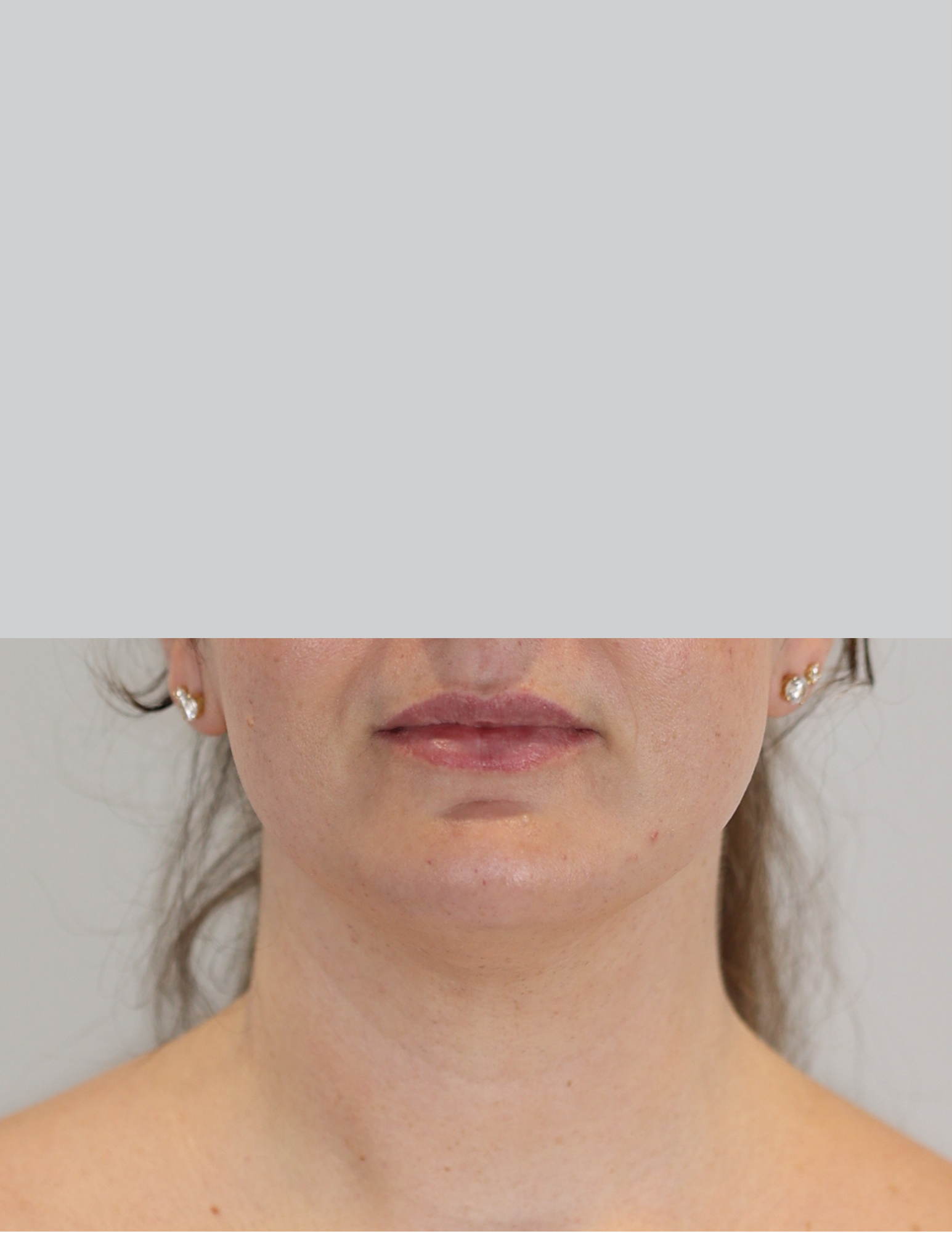 Neck (Chin) Liposuction