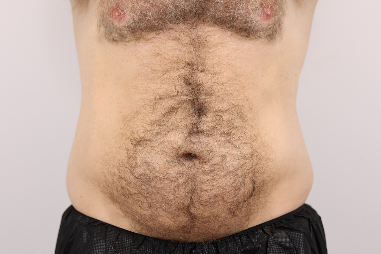 Abdomen & Waist/Flank Liposuction (Lipo 360)