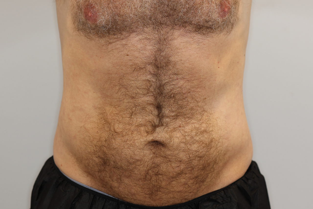 Abdomen & Waist/Flank Liposuction (Lipo 360)