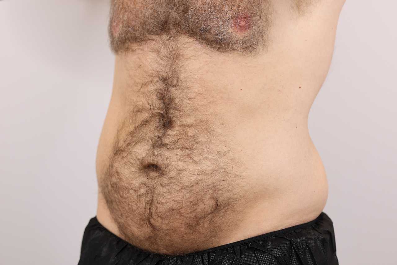 Abdomen & Waist/Flank Liposuction (Lipo 360)