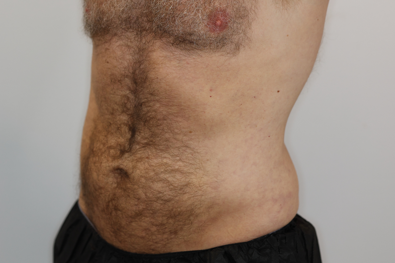 Abdomen & Waist/Flank Liposuction (Lipo 360)