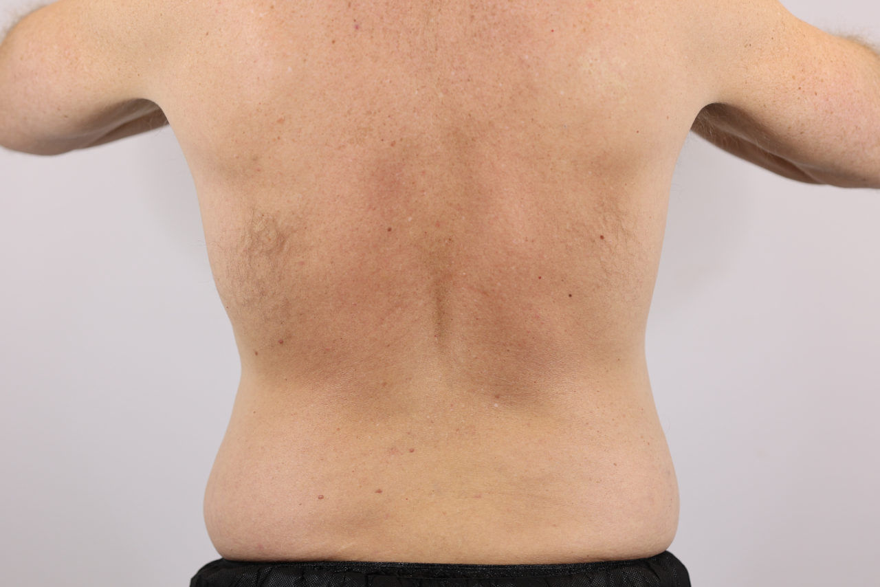 Abdomen & Waist/Flank Liposuction (Lipo 360)