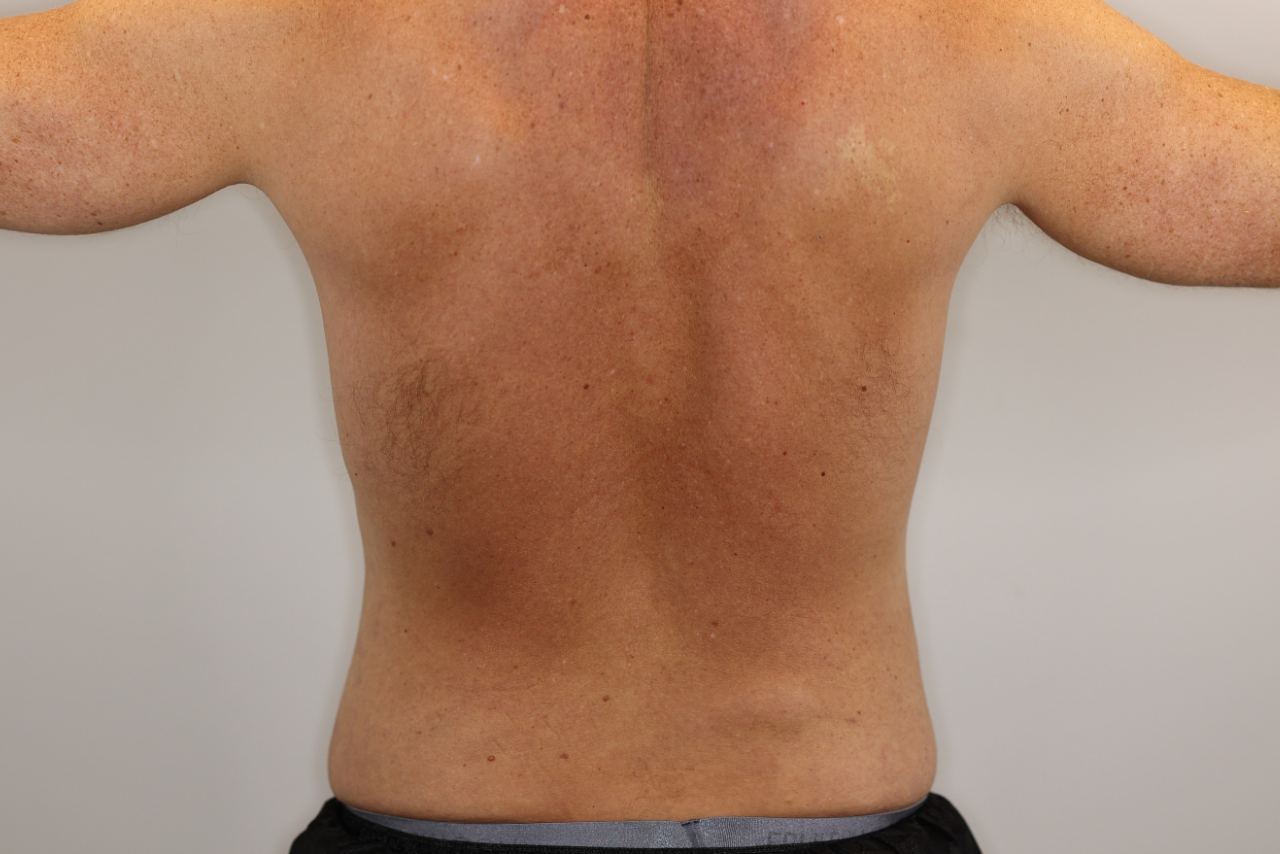 Abdomen & Waist/Flank Liposuction (Lipo 360)