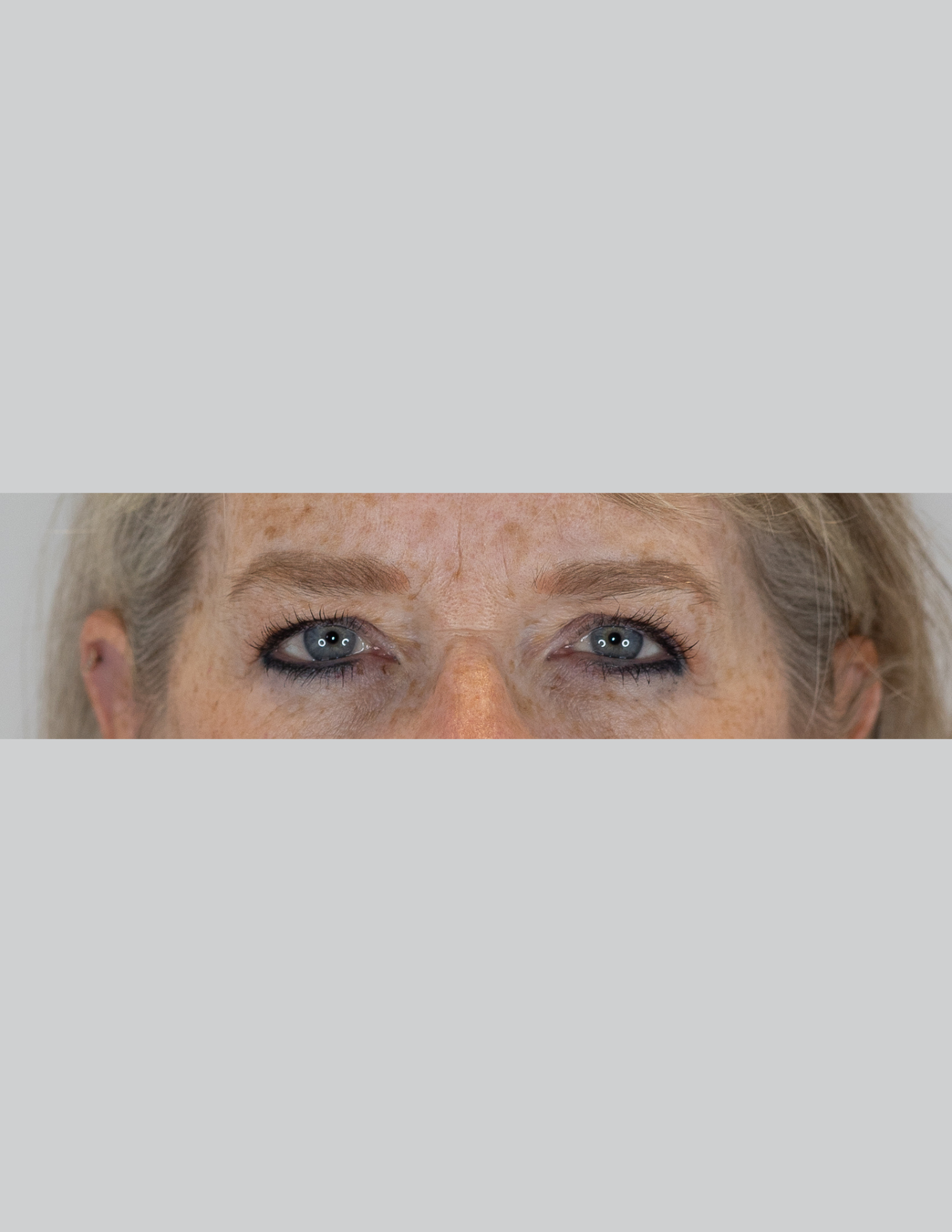 Eyelid Surgery (Upper Blepharoplasty)