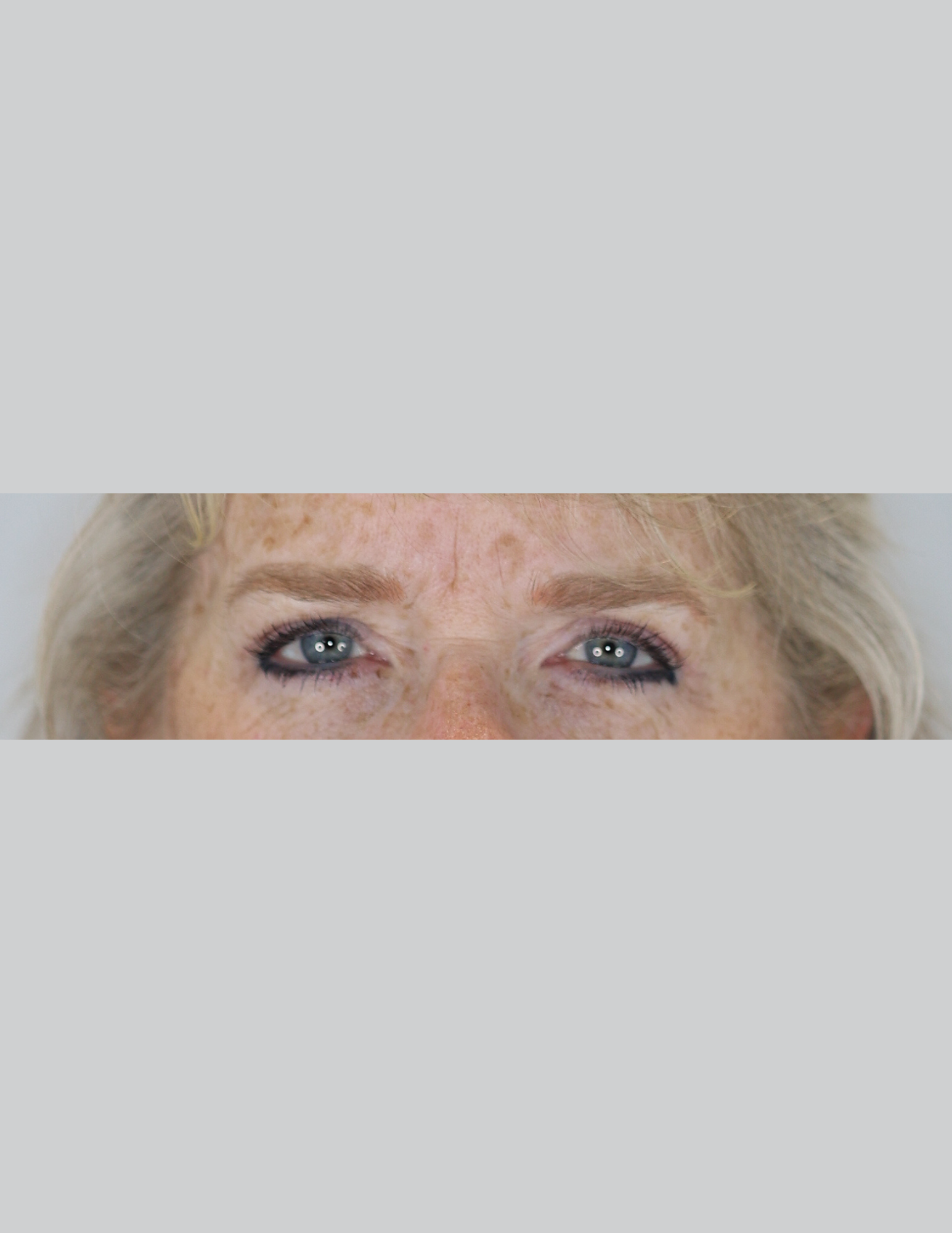 Eyelid Surgery (Upper Blepharoplasty)