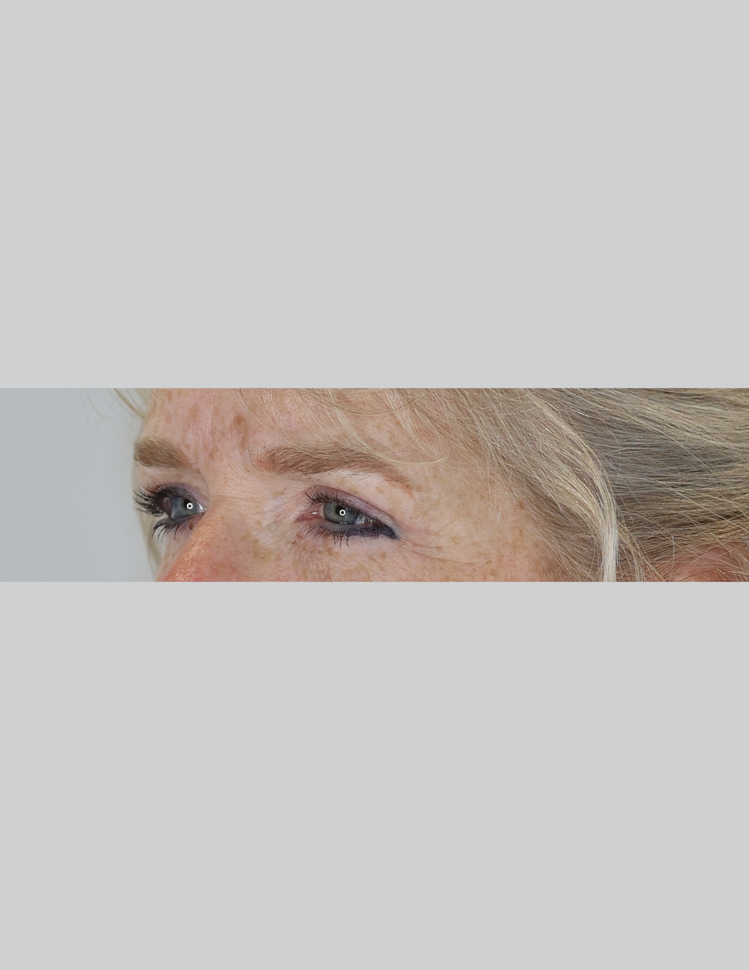 Eyelid Surgery (Upper Blepharoplasty)