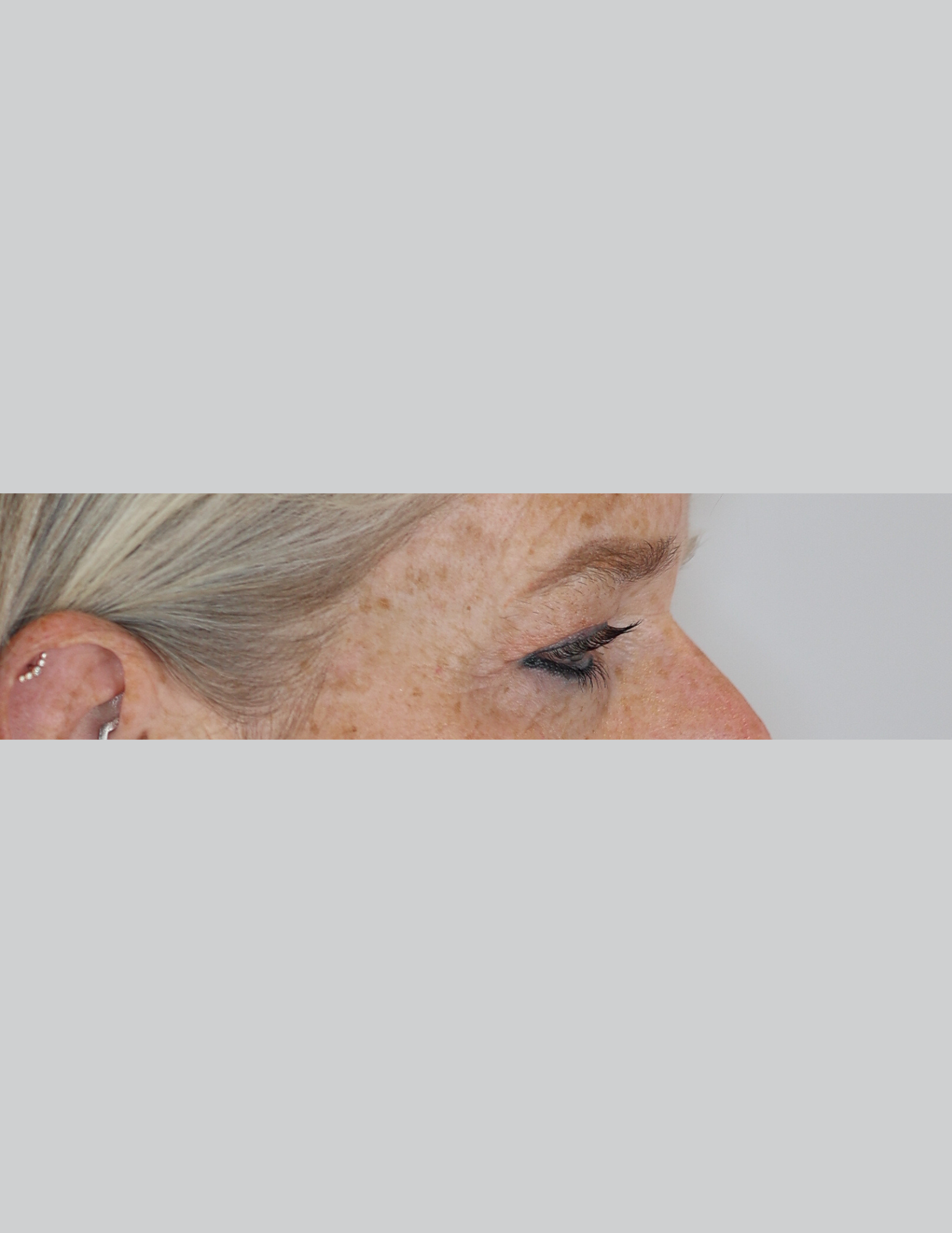 Eyelid Surgery (Upper Blepharoplasty)
