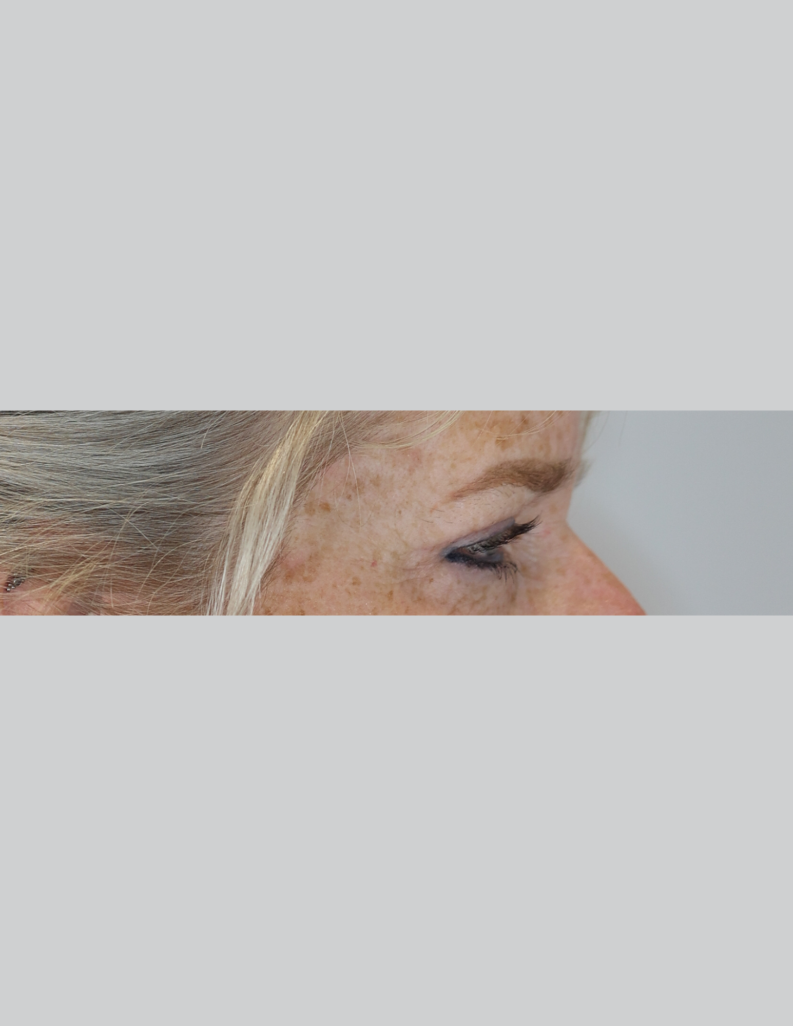 Eyelid Surgery (Upper Blepharoplasty)