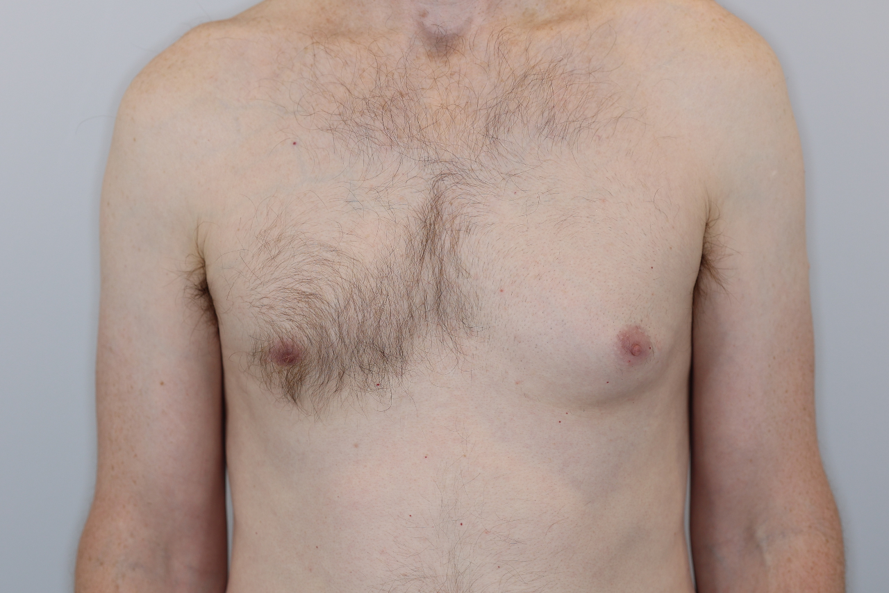 Gynecomastia