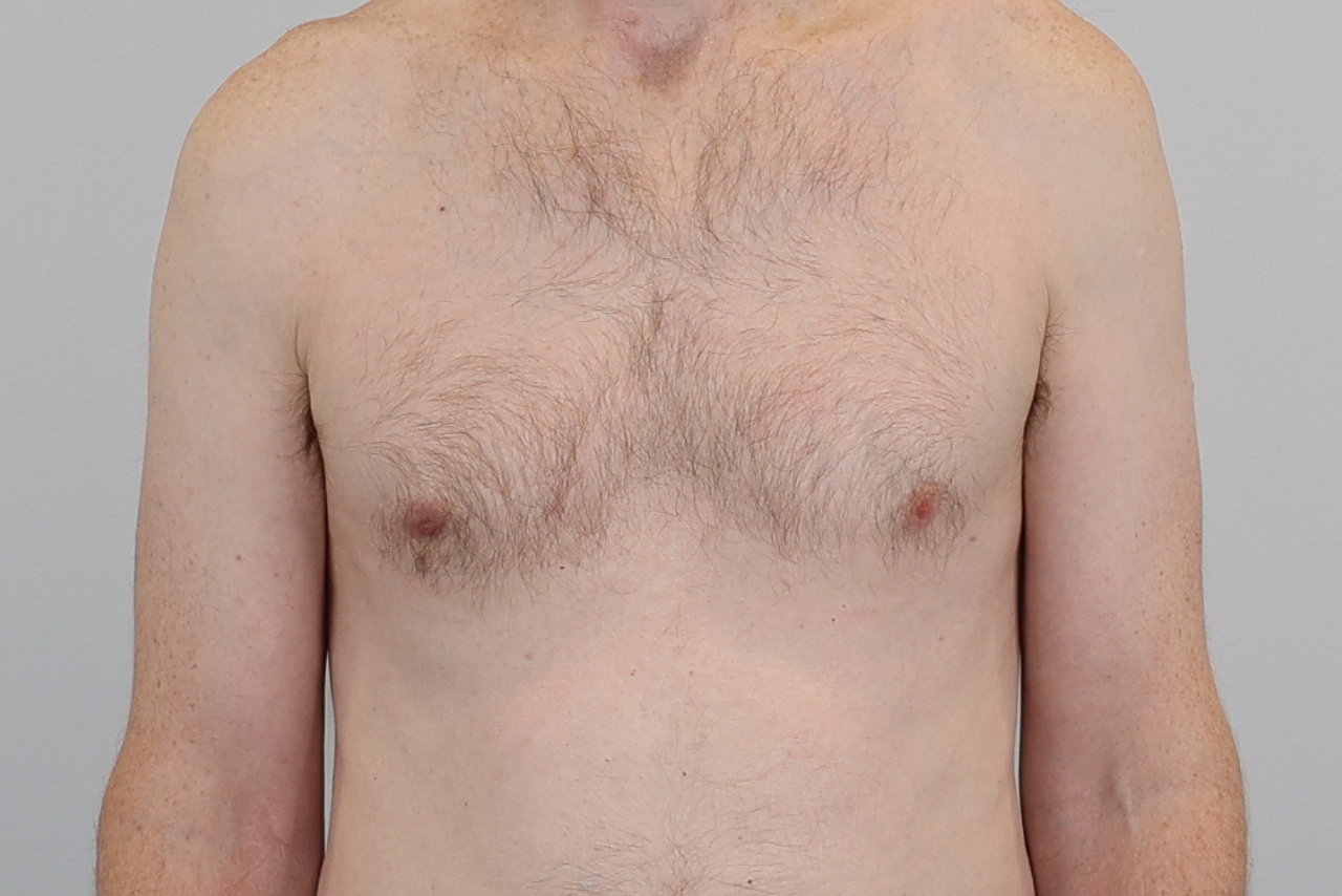 Gynecomastia 