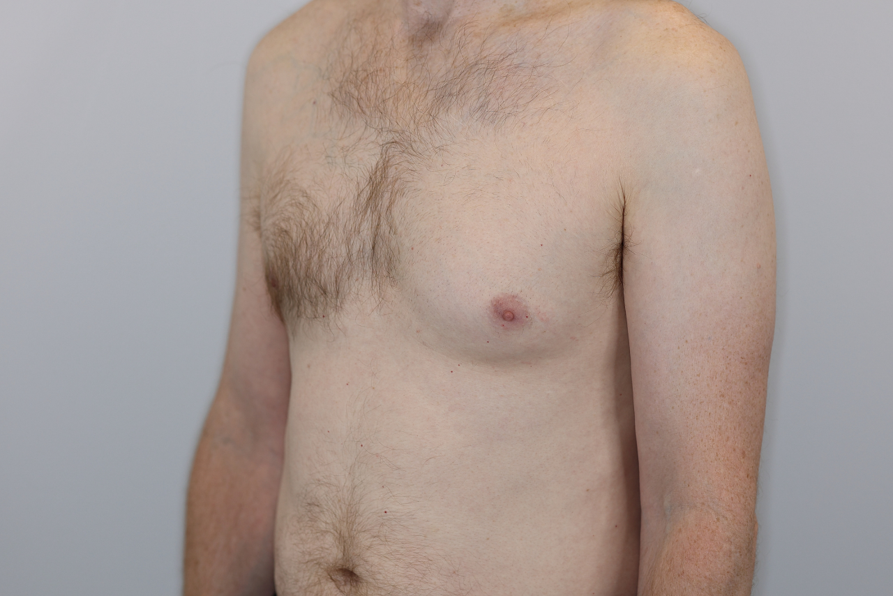 Gynecomastia 
