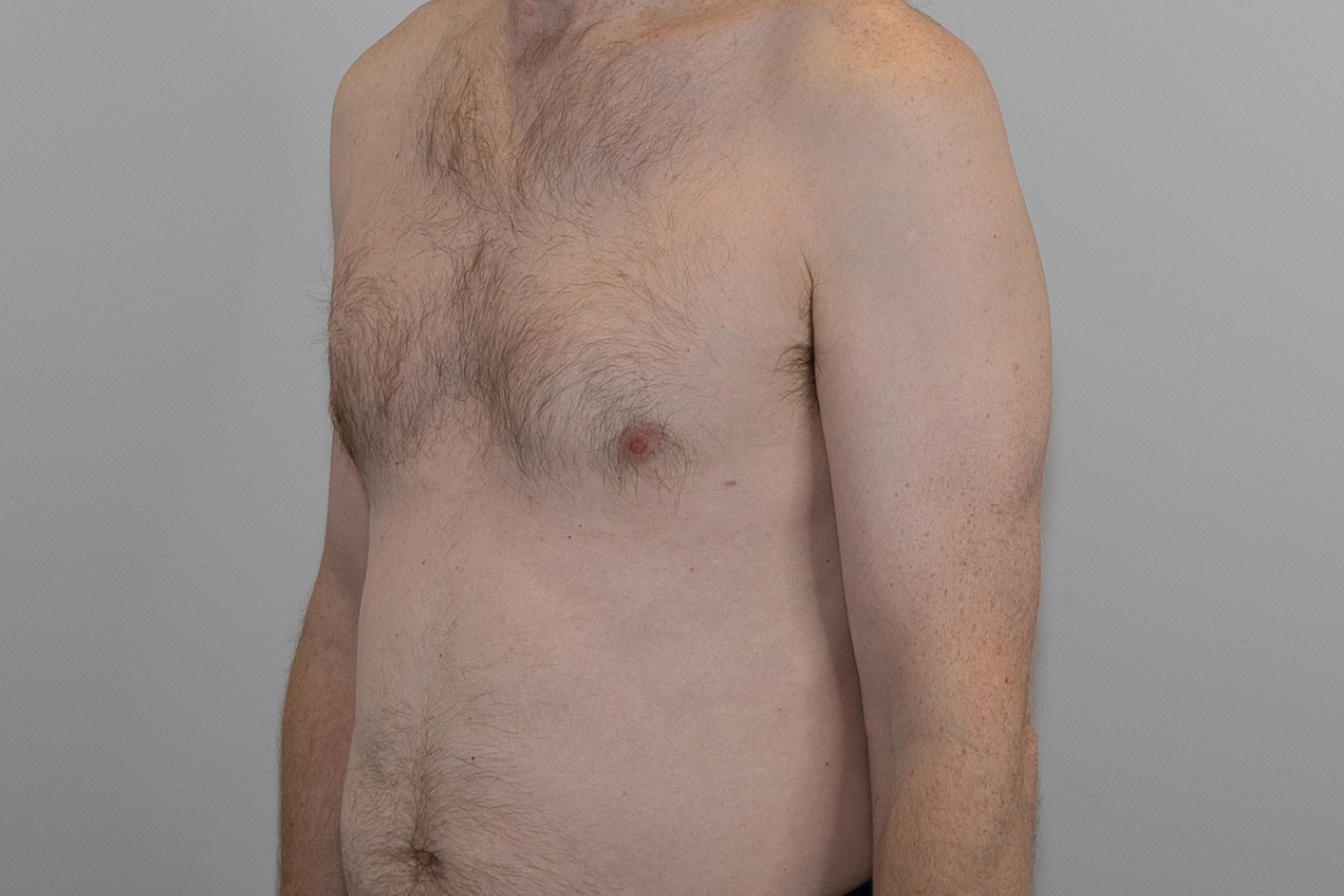 Gynecomastia 