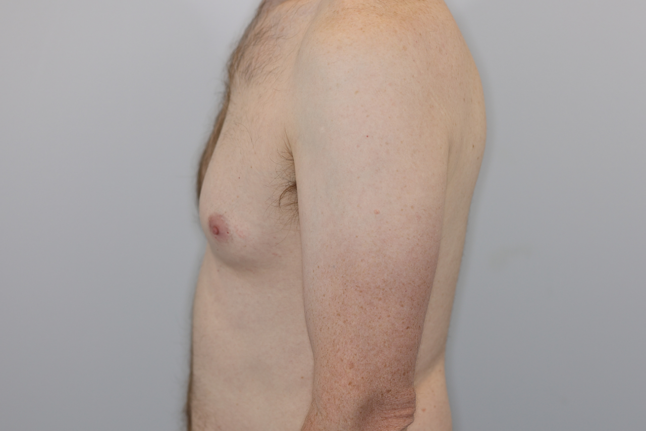 Gynecomastia 