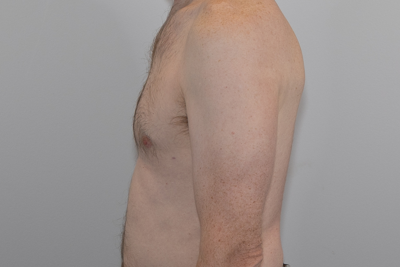 Gynecomastia 