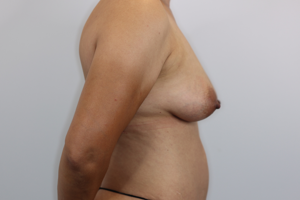 Fat Transfer to Breasts