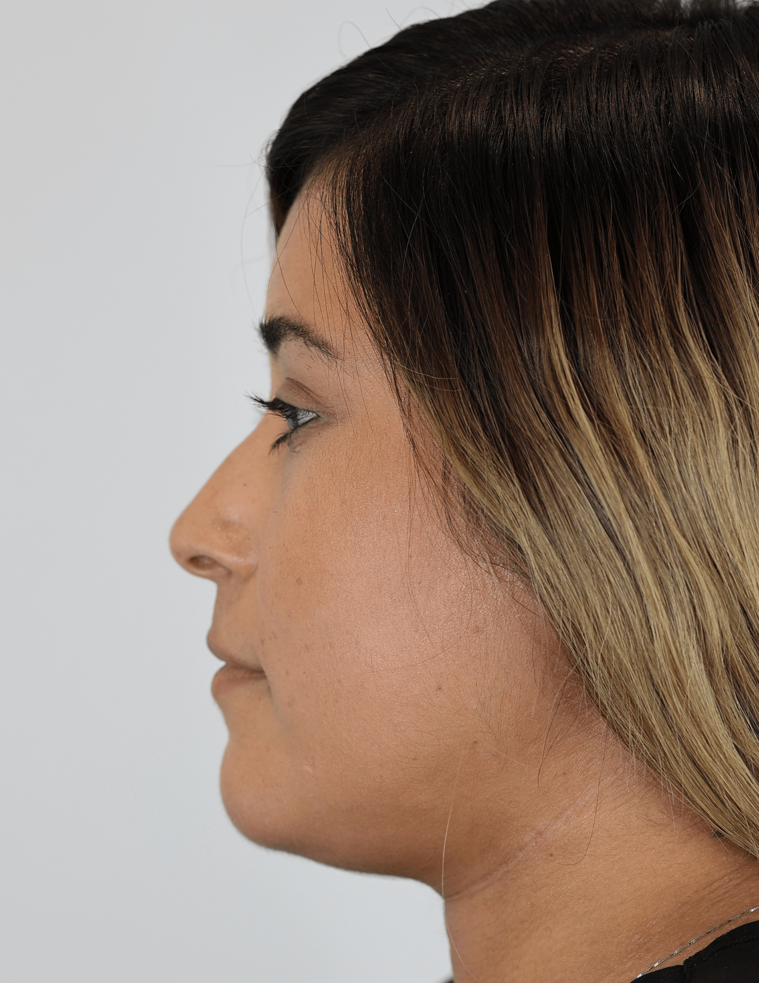 Lip Filler