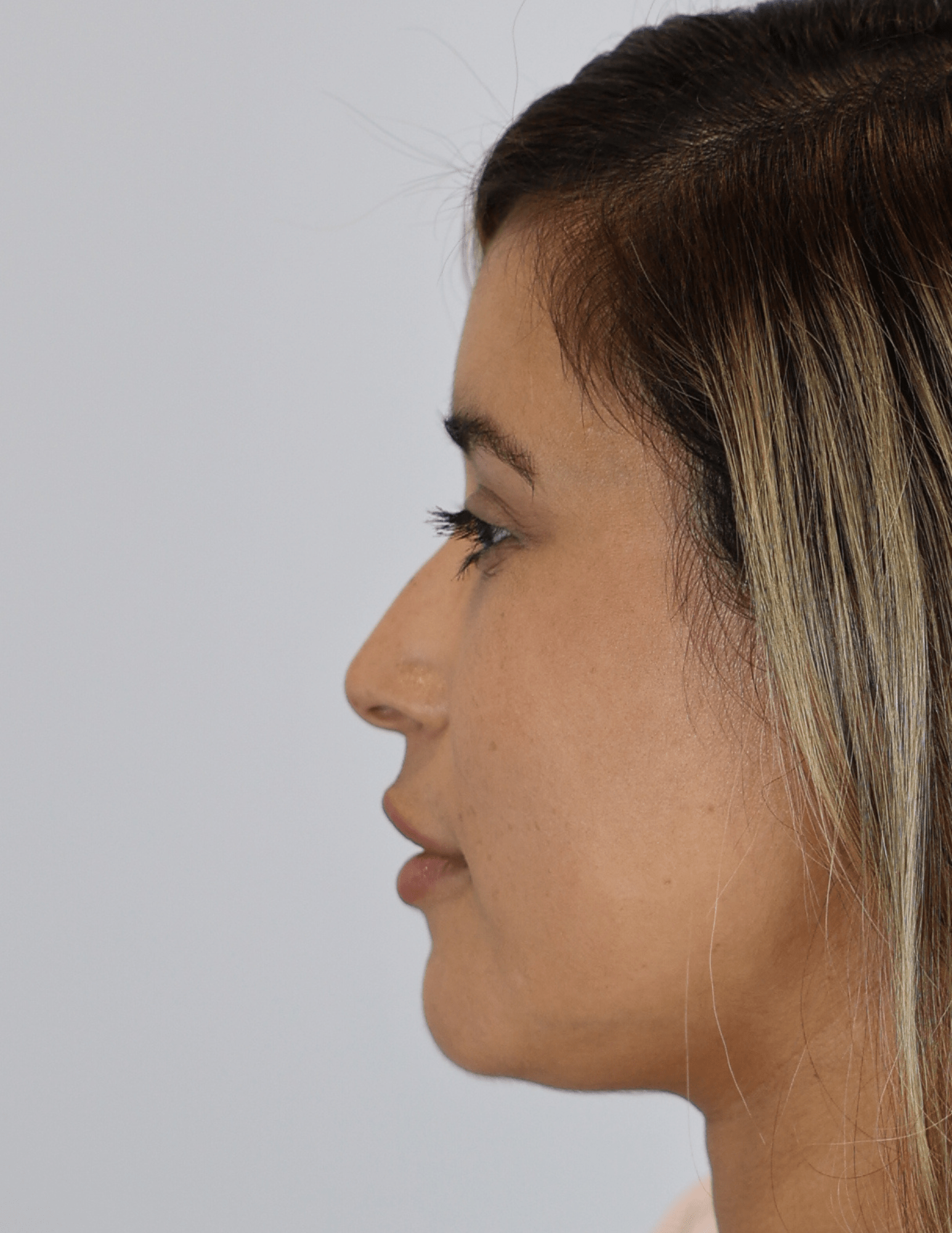 Lip Filler