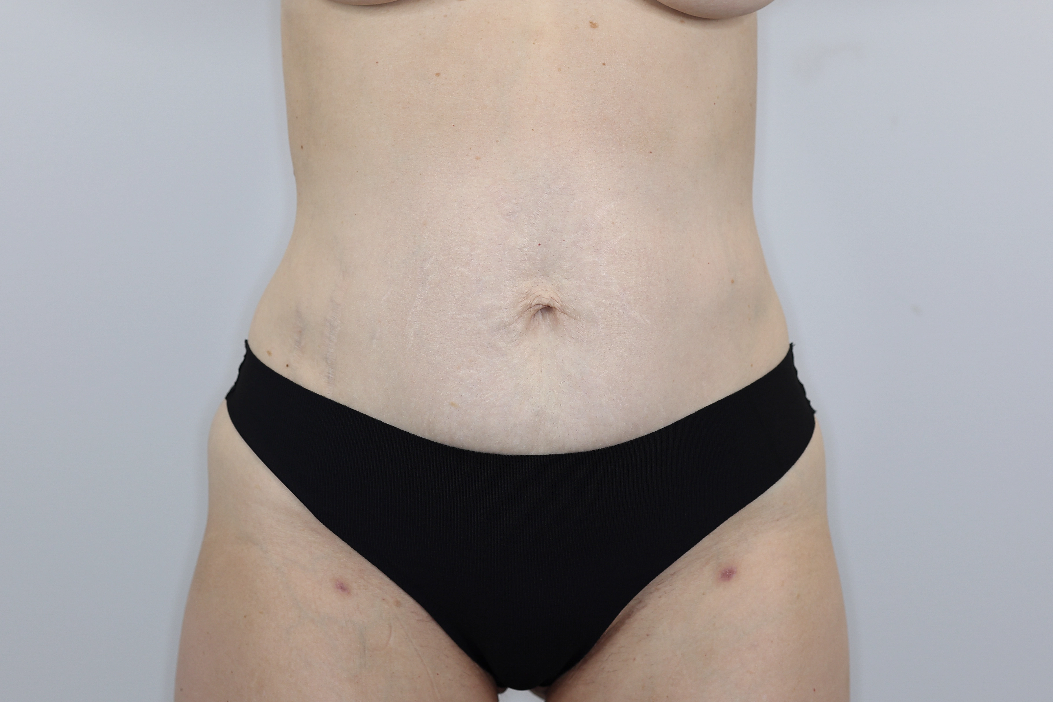 Tummy Tuck