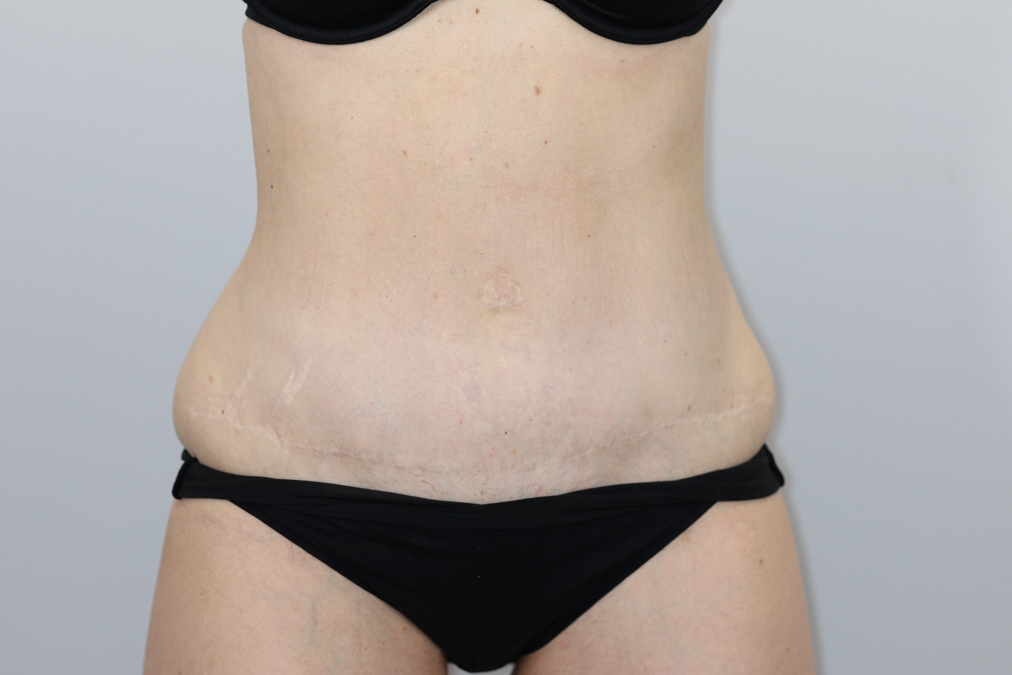 Tummy Tuck