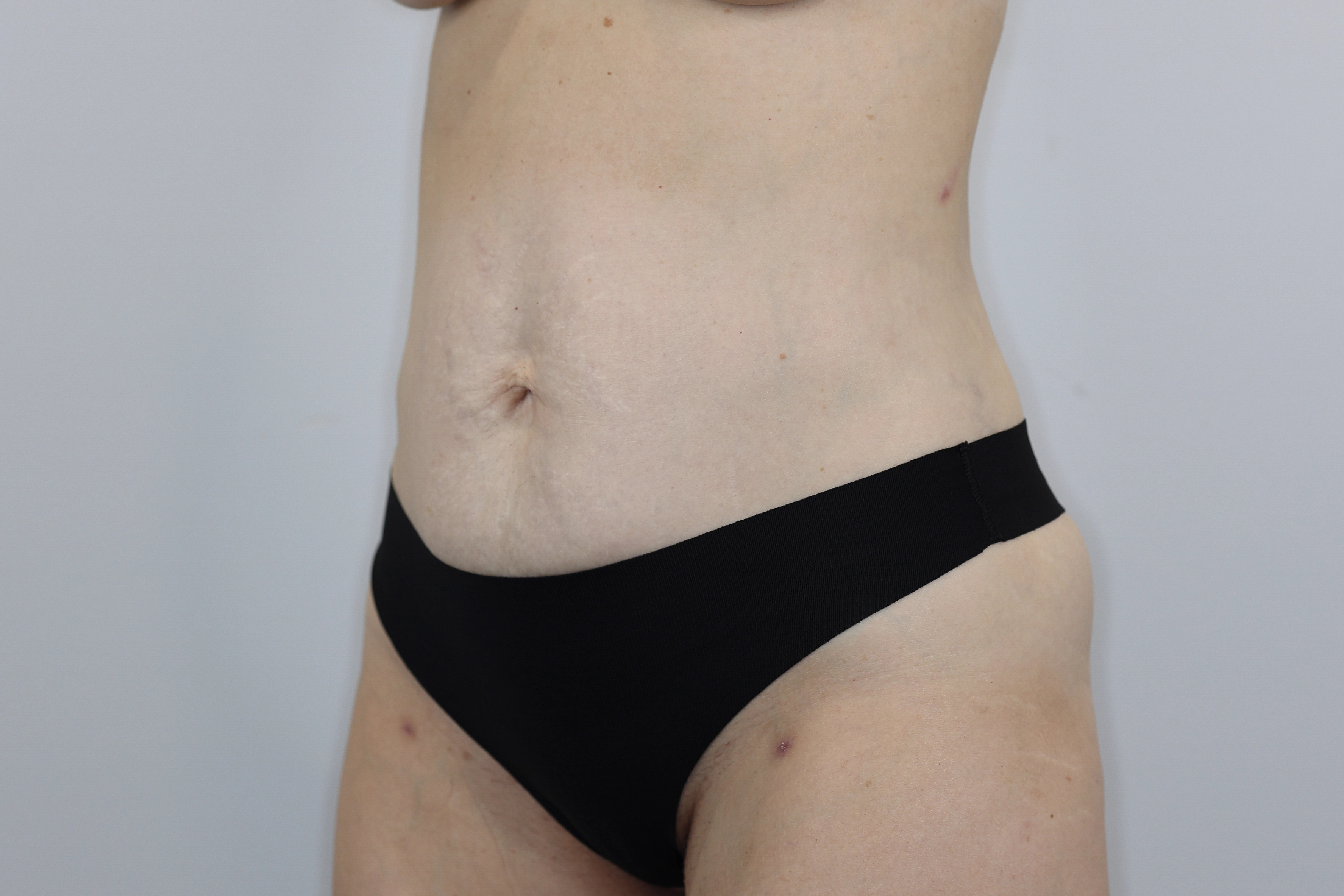 Tummy Tuck