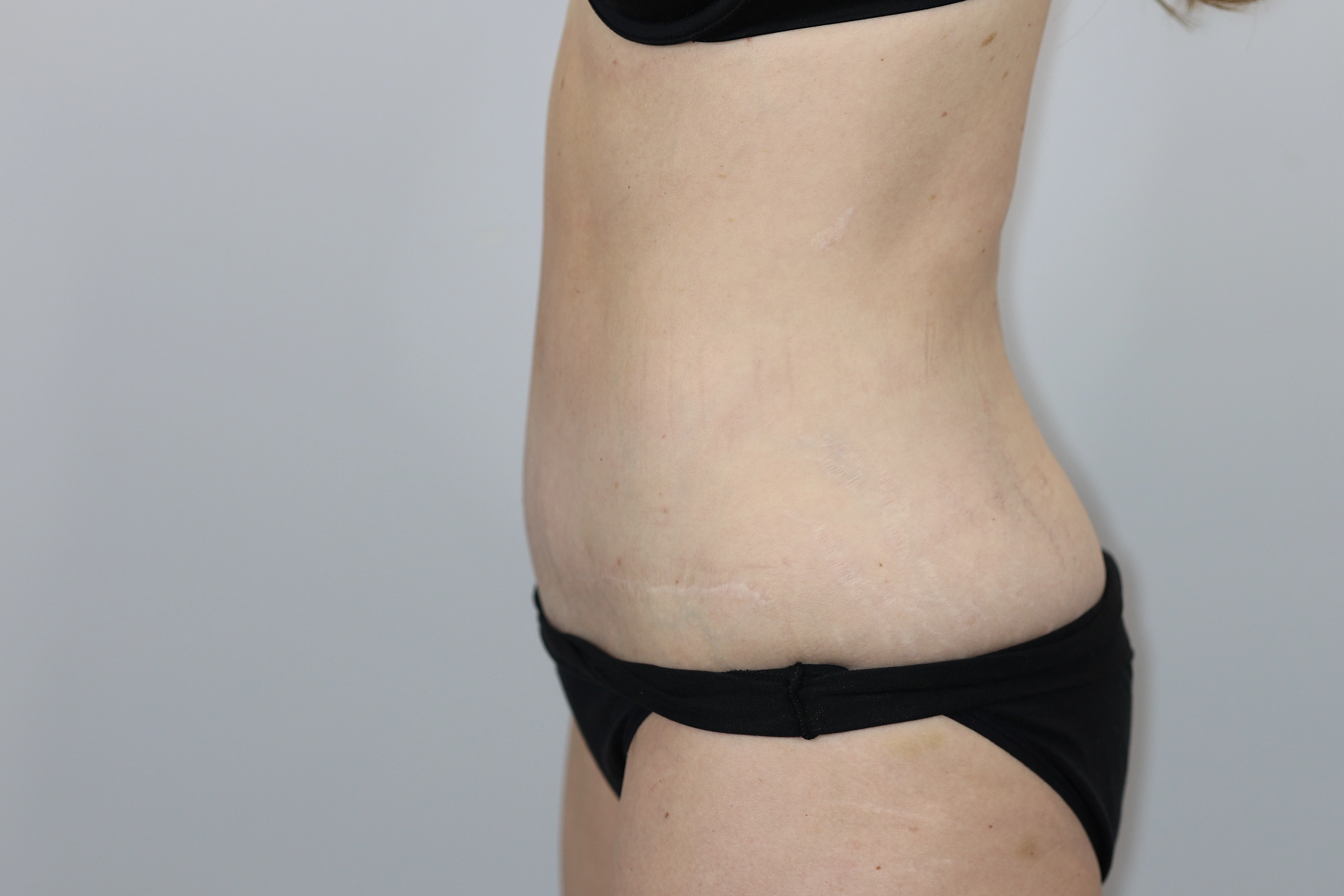 Tummy Tuck