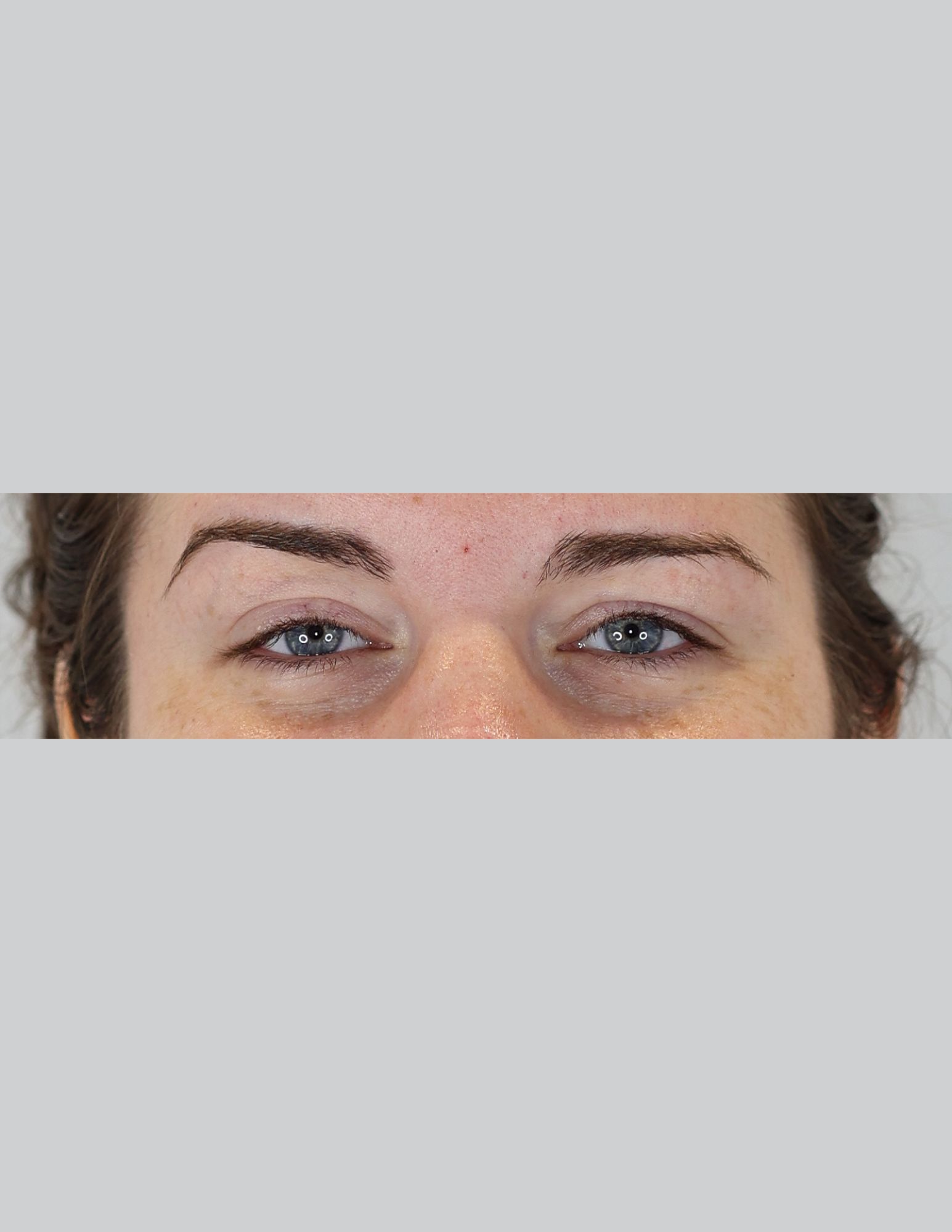 Eyelid Surgery (Upper Blepharoplasty & Ptosis Repair)