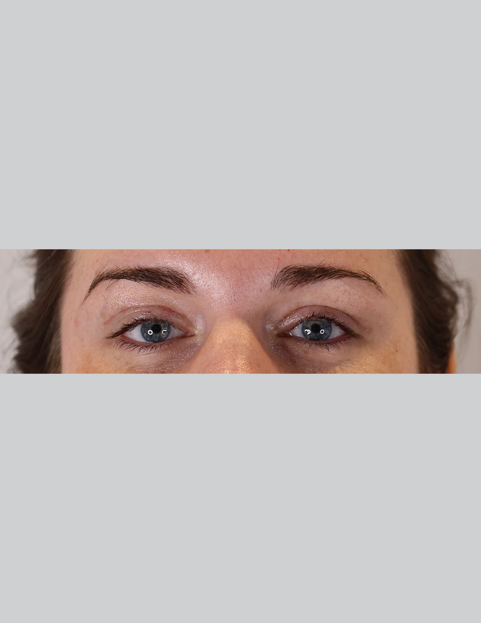 Eyelid Surgery (Upper Blepharoplasty & Ptosis Repair)
