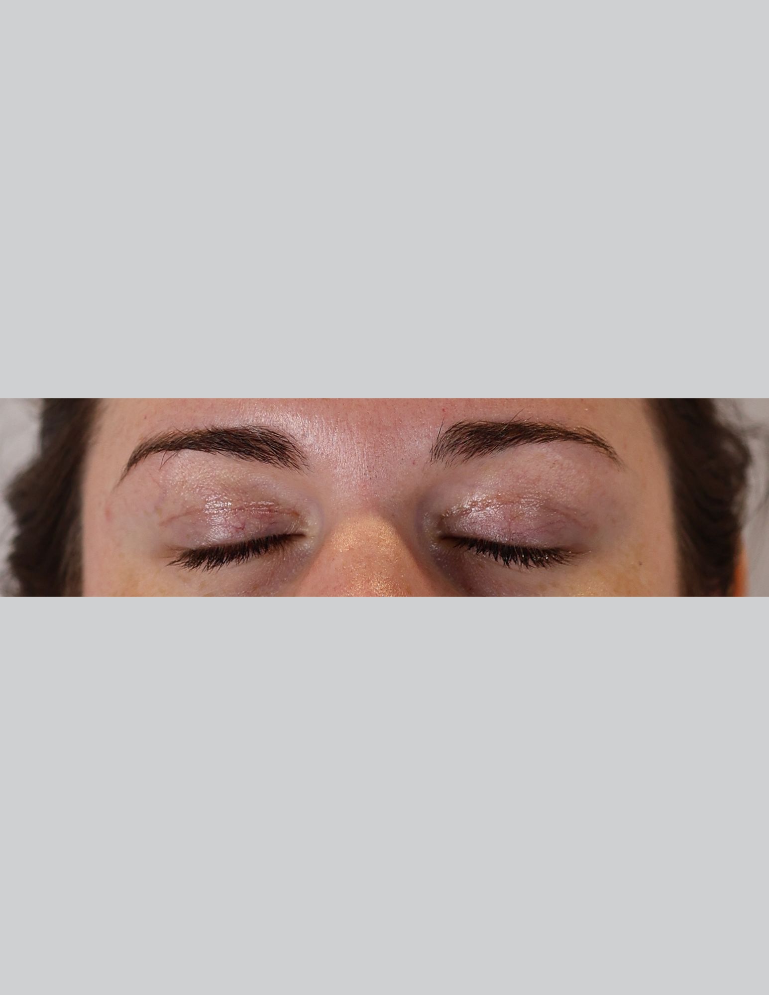 Eyelid Surgery (Upper Blepharoplasty & Ptosis Repair)