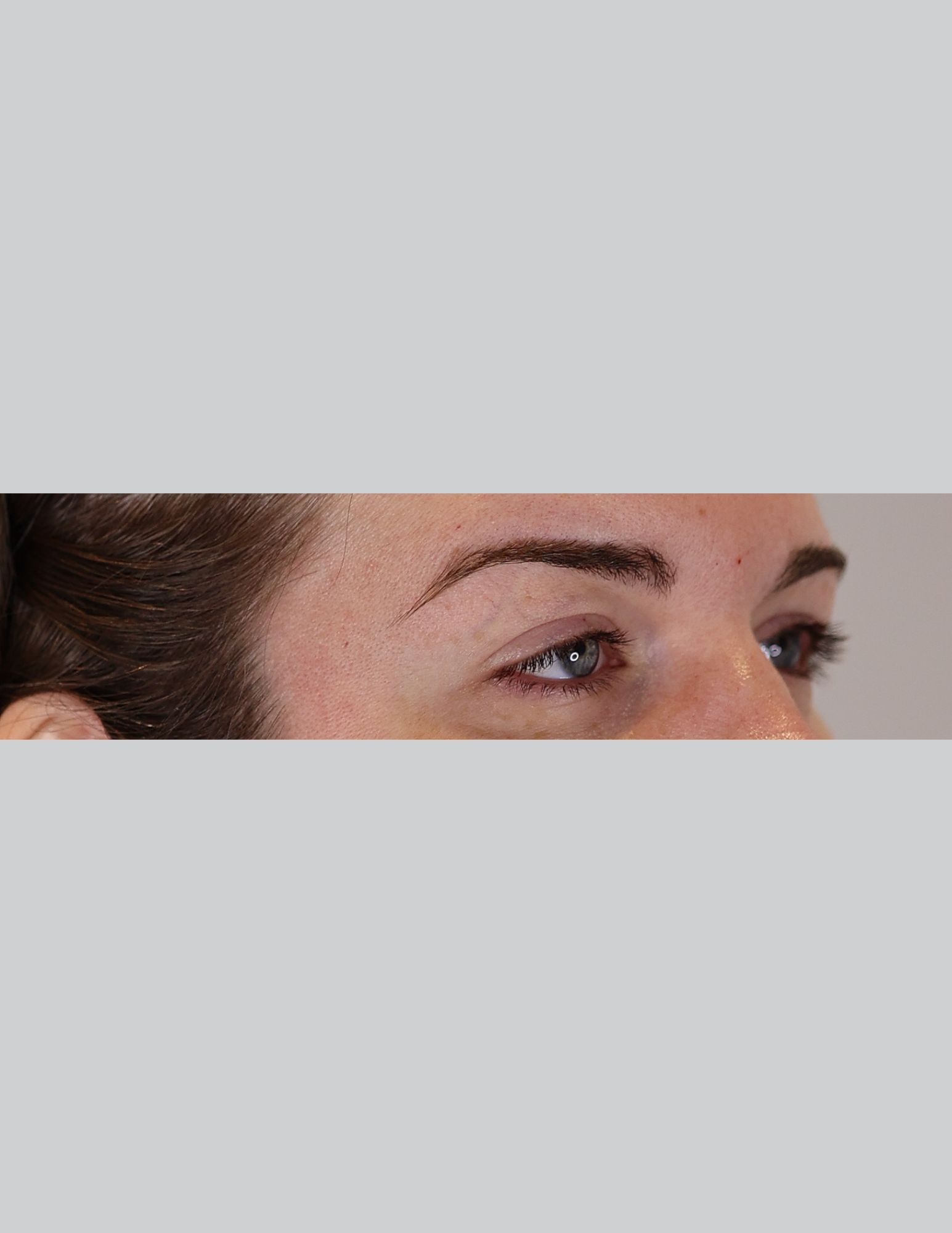 Eyelid Surgery (Upper Blepharoplasty & Ptosis Repair)