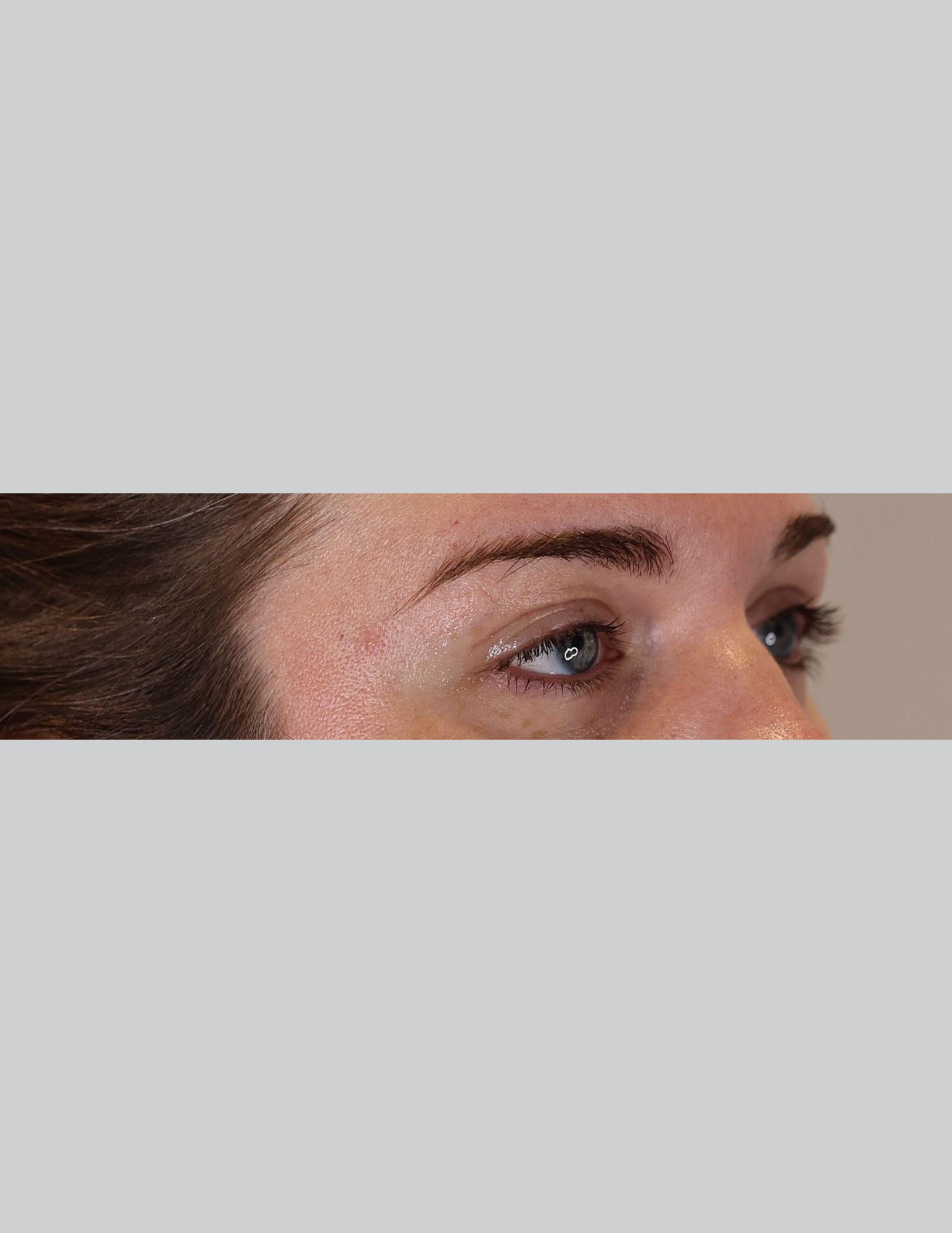 Eyelid Surgery (Upper Blepharoplasty & Ptosis Repair)