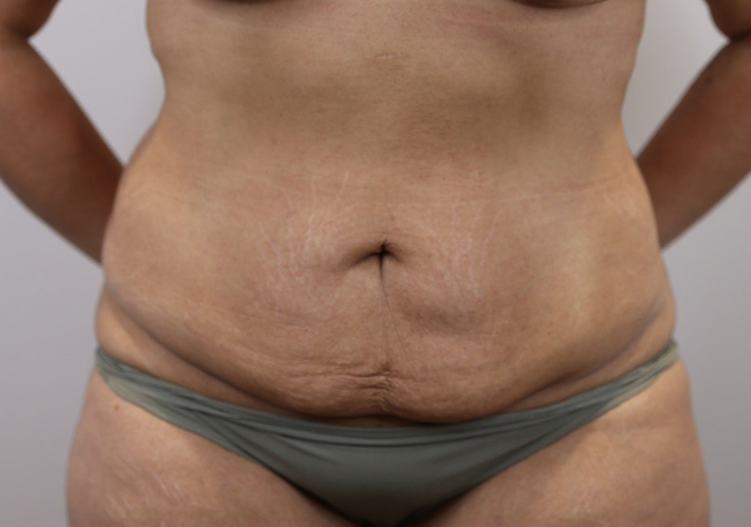 Tummy Tuck & Waist/Flank Liposuction