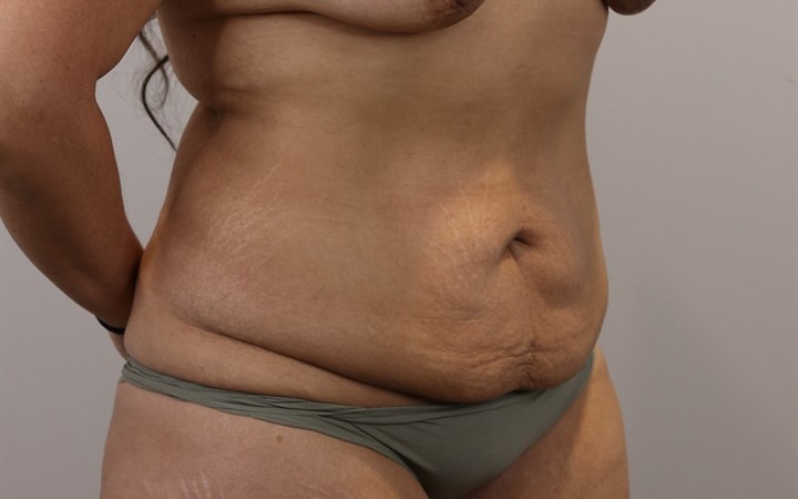 Tummy Tuck & Waist/Flank Liposuction