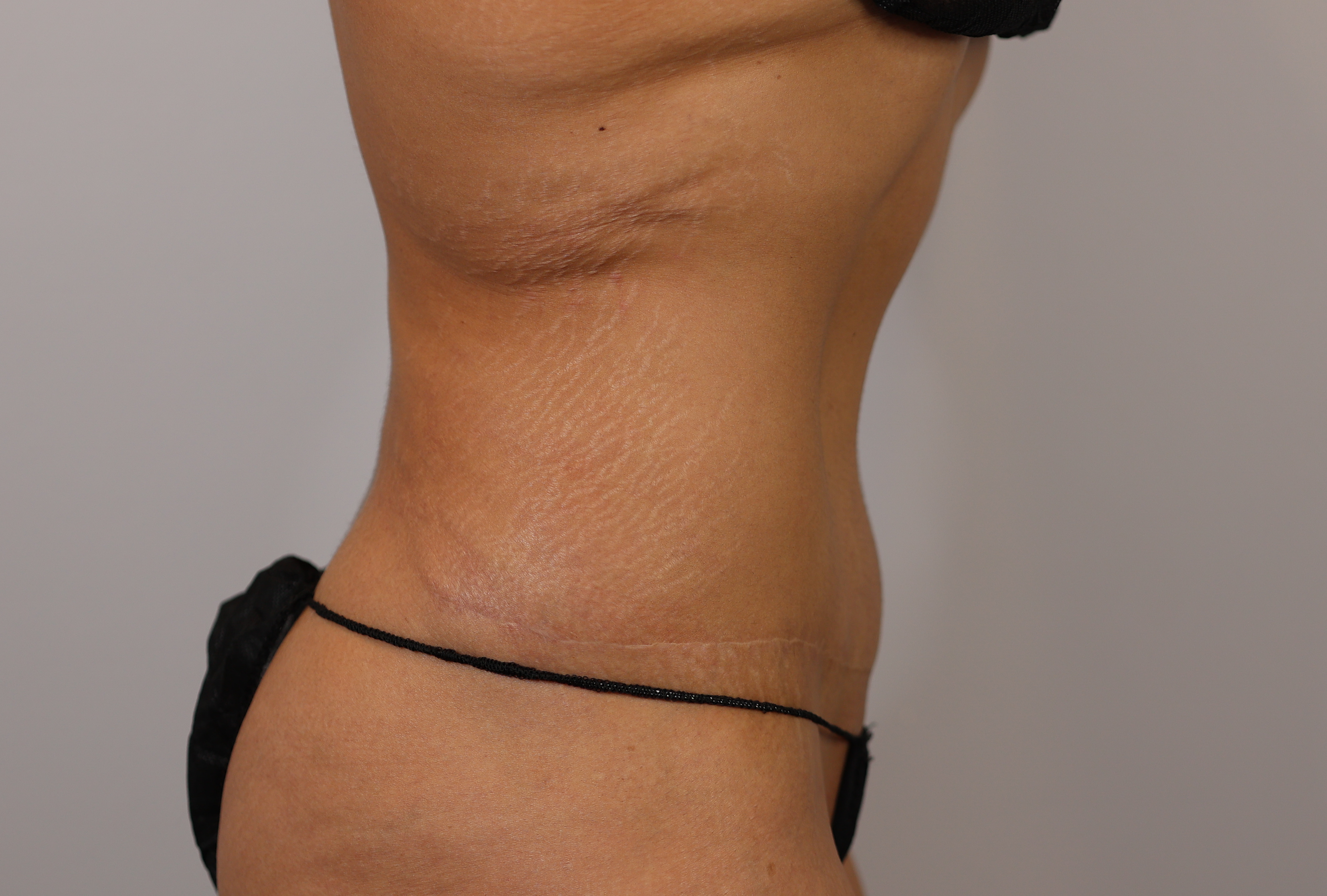 Tummy Tuck & Waist/Flank Liposuction