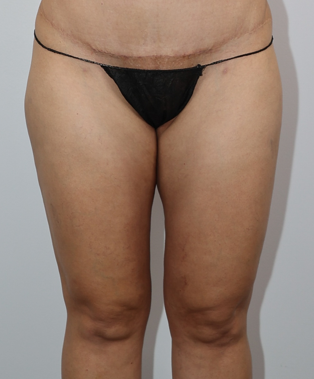 Thigh Liposuction