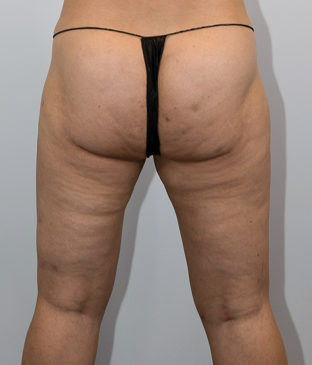 Thigh Liposuction