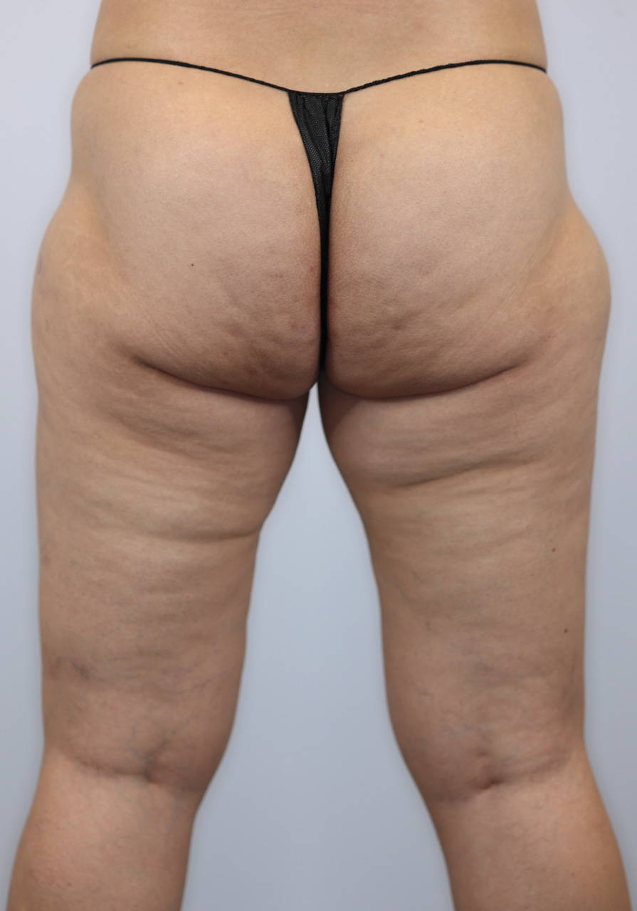 Thigh Liposuction