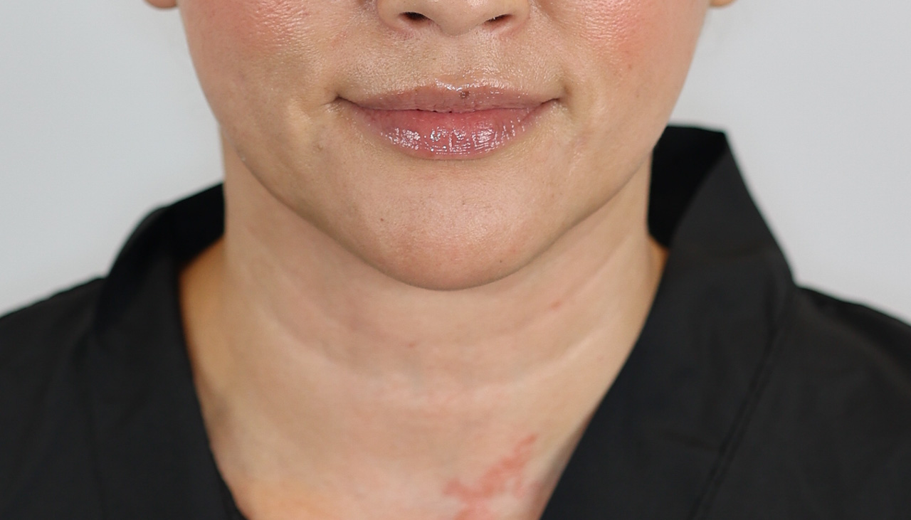 Neck (Under Chin) Liposuction