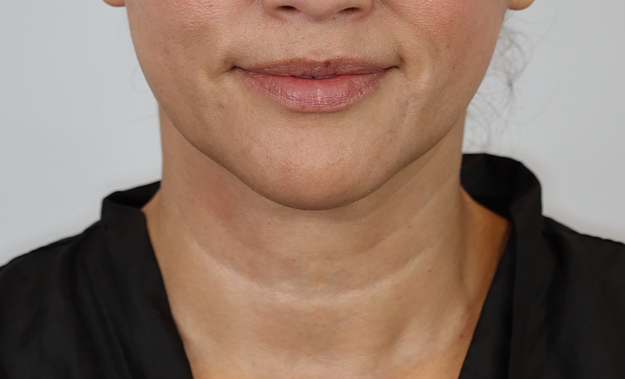 Neck (Under Chin) Liposuction