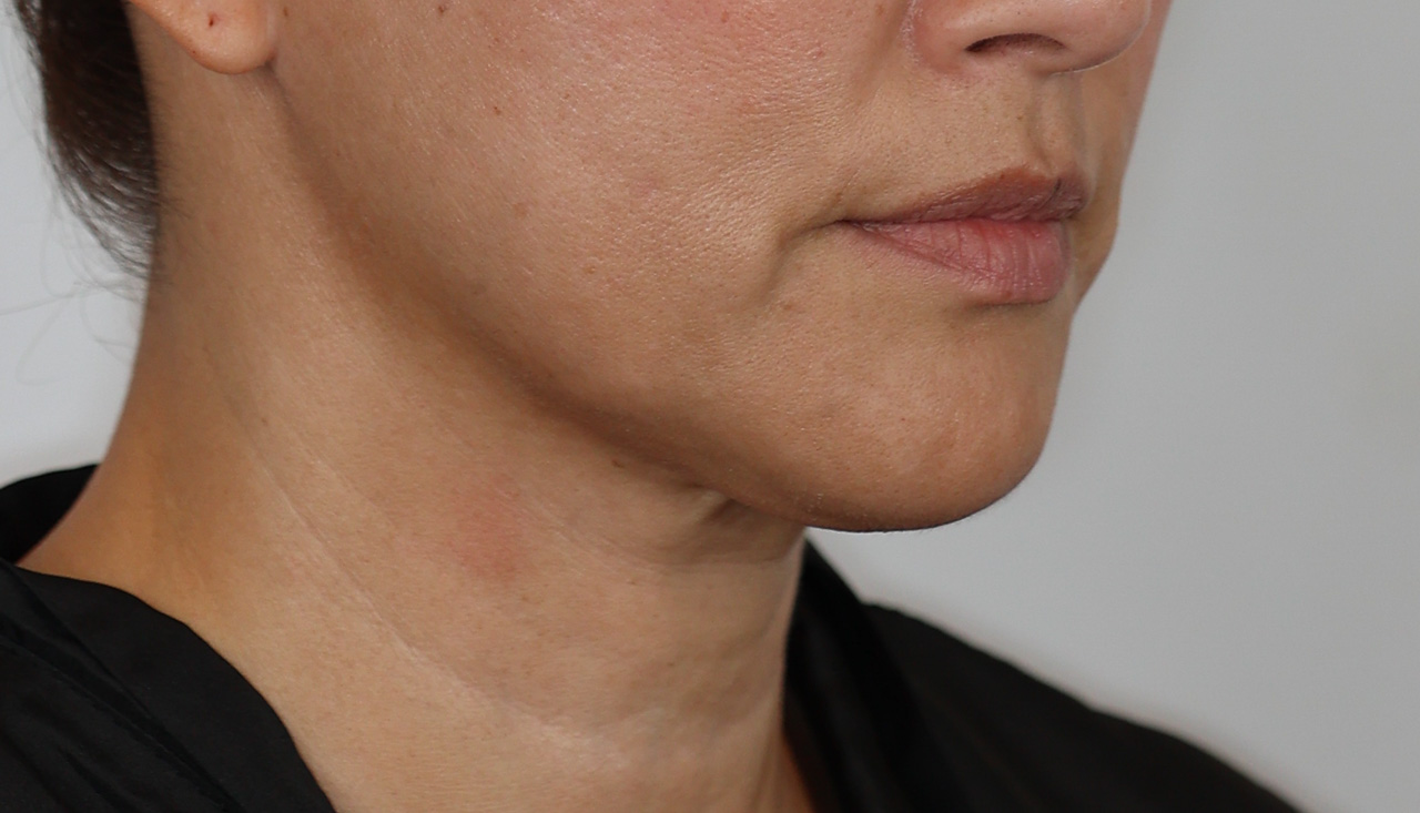 Neck (Under Chin) Liposuction
