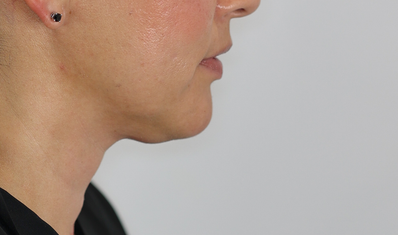 Neck (Under Chin) Liposuction